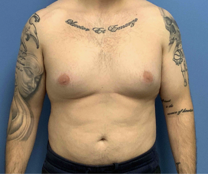 Gynecomastia-with-Liposuction | Before Liposuction